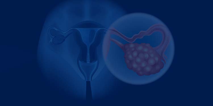 Gynecological Cancer Treatment